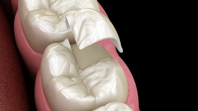 Animation frame: a crown being placed on a molar