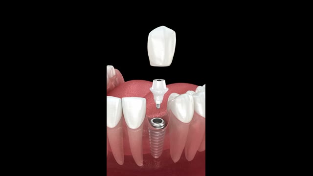 Animation frame: implant, abutment and crown replacing a missing tooth