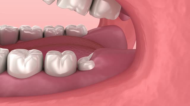 Animation frame: wisdom tooth removal